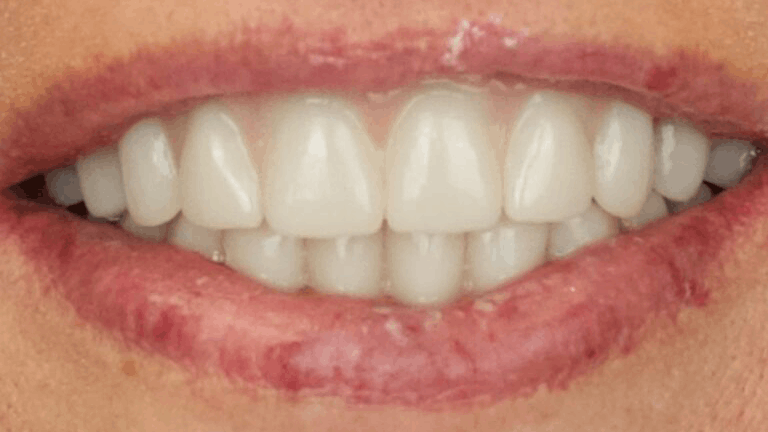 Implant Reconstruction — after