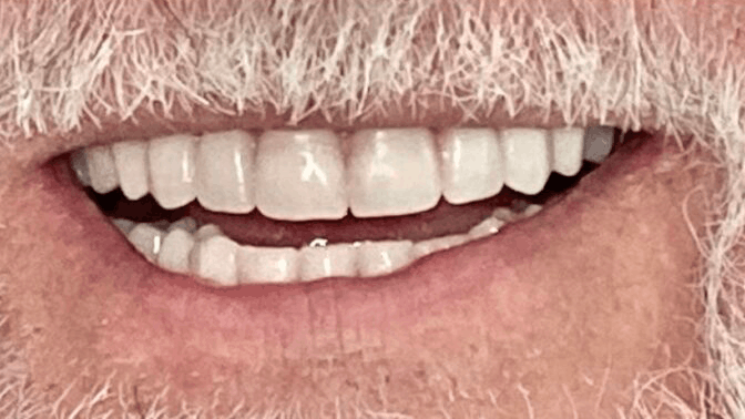 All-On-4 Implants — after