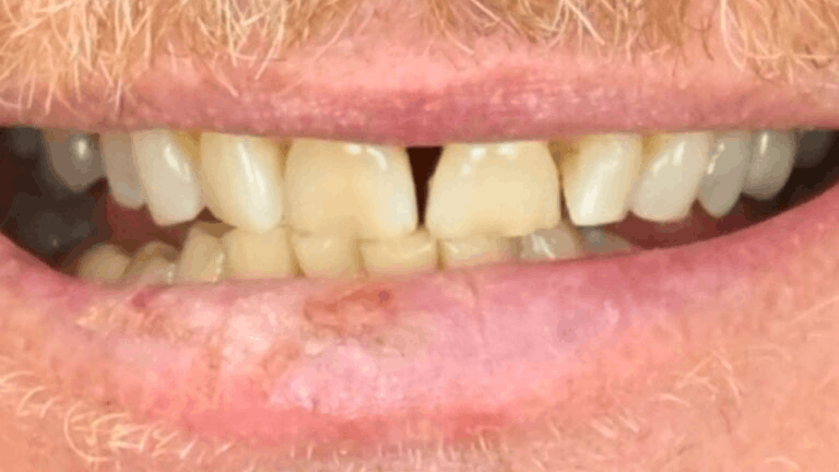Full Arch Restoration — before