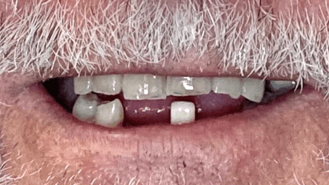 All-On-4 Implants — before