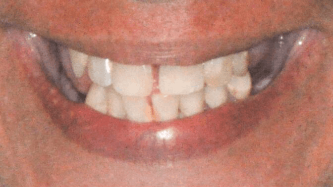Smile Transformation — before