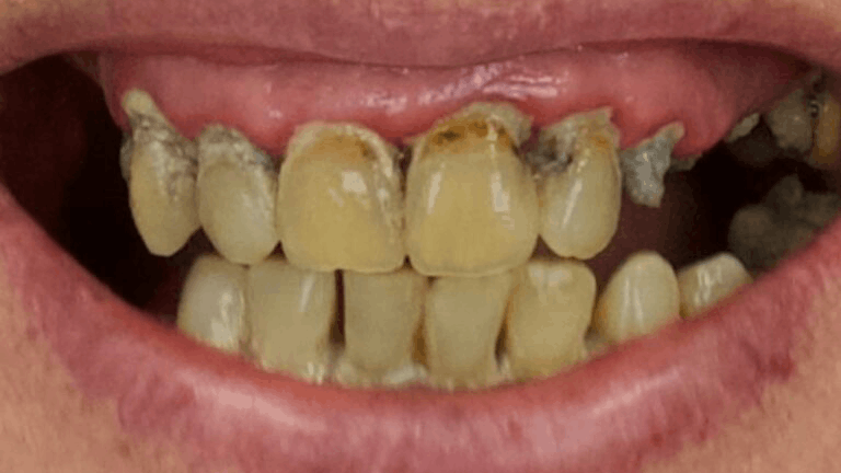 Implant Reconstruction — before