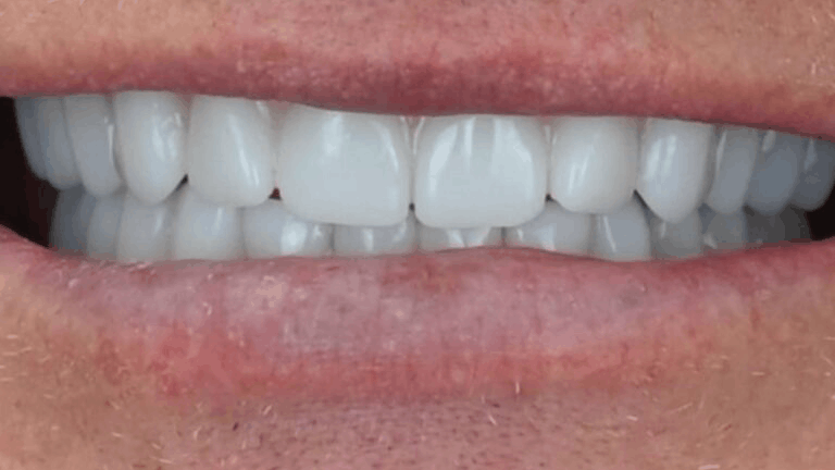 Full Arch Restoration — after