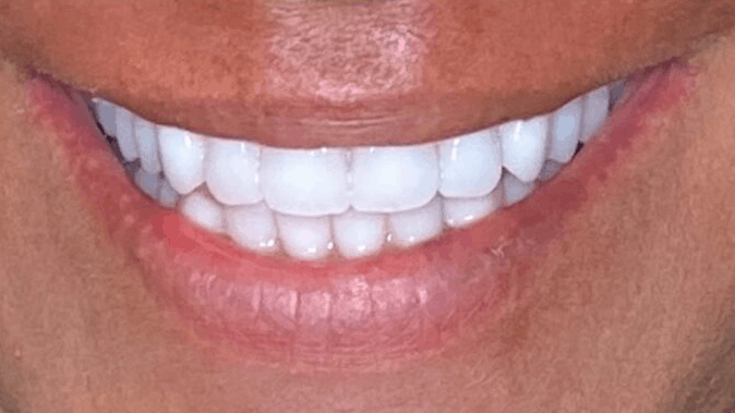 Smile Transformation — after